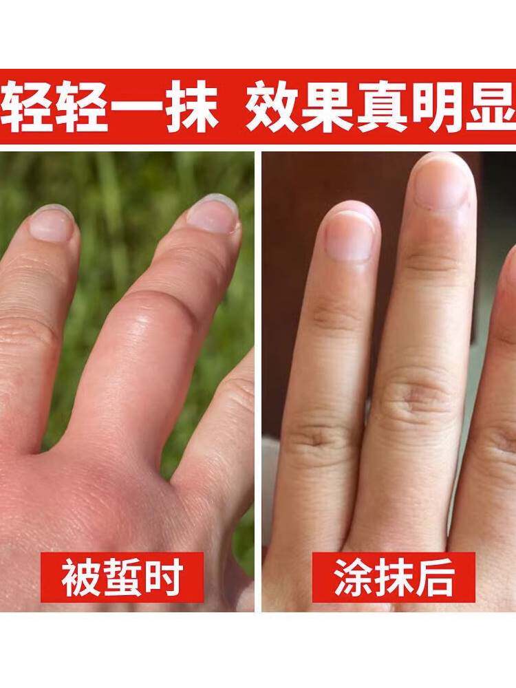 现货速发马蜂蛰伤药膏治蜂王蛰伤的药蚊虫叮咬专用药消红止痛养蜂