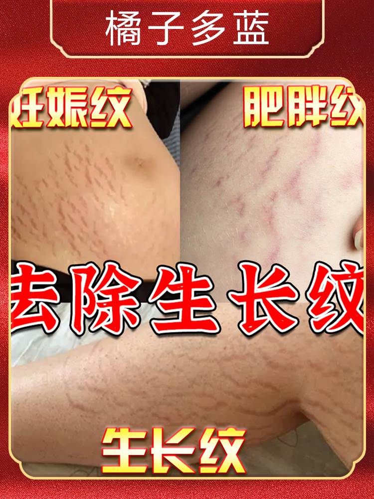 速发消除生长纹学生大腿上肥胖纹淡化去除屁股纹预防妊娠纹紧致修