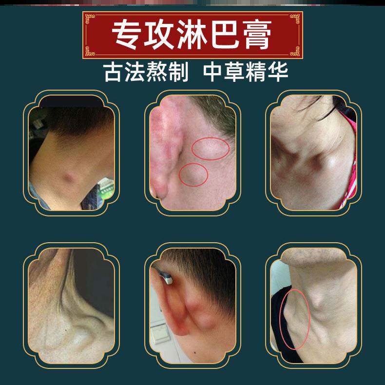 速发淋巴结节解散膏去副乳神器乳腺增生散结贴中乳房胀痛药消除贴