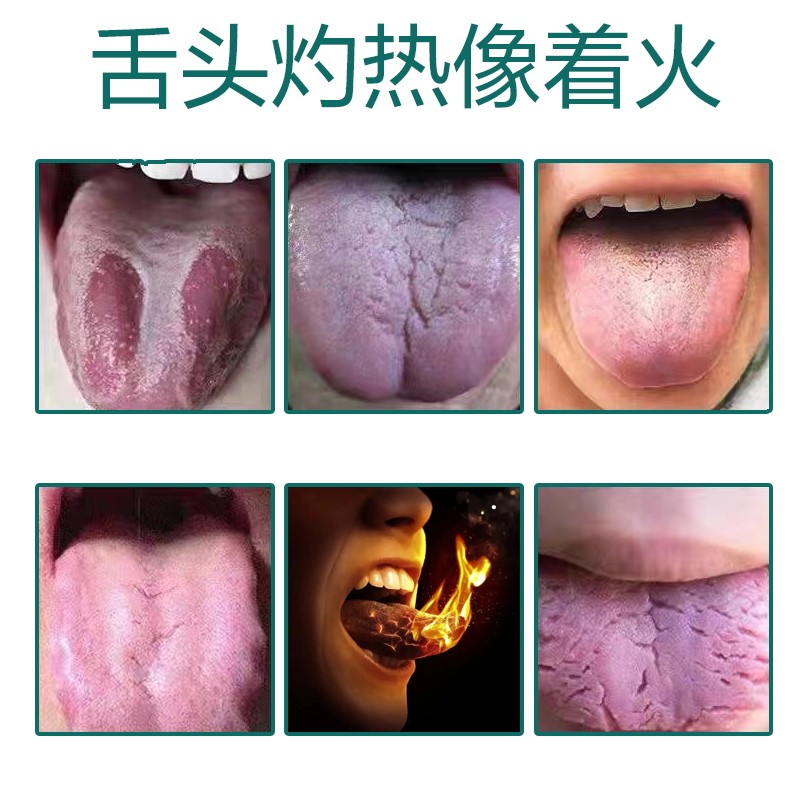 速发嘴巴上火起泡烂口腔上火嘴巴舌头烂口腔内壁起小白泡莲花清桔