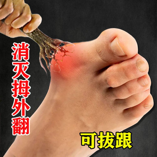 热销【可拔跟】脚骨脚趾重叠专用膏贴拇外翻神器拇指外翻矫正专用