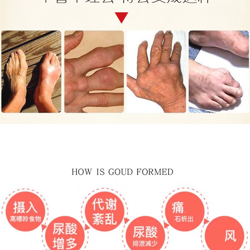 工厂销手指关节变形肿大骨节粗大内风湿关节疼痛僵硬腱Y鞘炎痛风