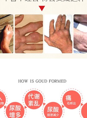 工厂销手指关节变形肿大骨节粗大内风湿关节疼痛僵硬腱Y鞘炎痛风