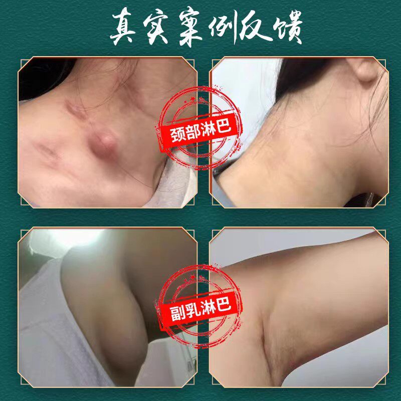 淋巴结通络膏淋巴肿大下颚腮腺帮子肿痛消除贴颈r部淋巴硬块散结