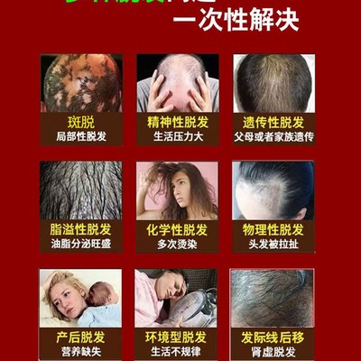 推荐鬼剃头药液防脱发女掉发头发斑脱男士专用严重剂抖音同款官网