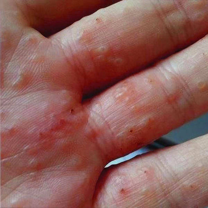 汗疱疹膏手上长小水泡湿疹膏脱皮开裂膏痒真菌感染止痒膏鹅掌风消