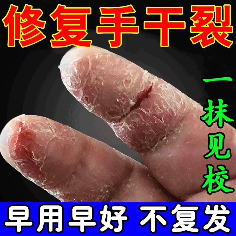 手脱皮药膏瘙痒起皮干裂干燥真菌感染手脚藓鹅掌风季节性起泡专用