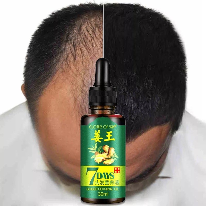 推荐Hair Loss Treatment Ginger Growth Essence Oil老姜头发养