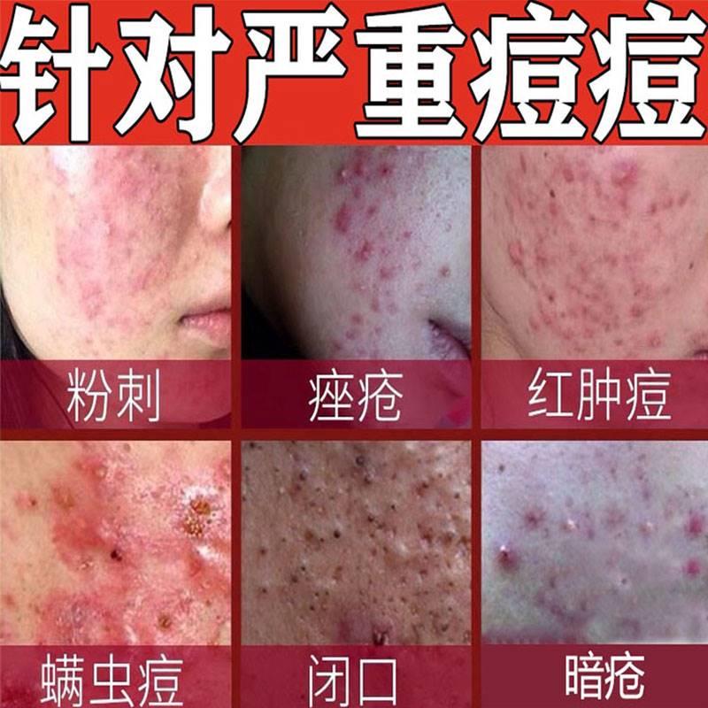 极速去淋巴痘腮边痘特效药下巴青春痘腮帮子脸颊脖子长痘根祛重度