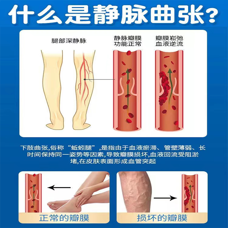 推荐腿上有红血丝静脉曲张专用喷剂毛细血管扩张青筋凸起烂腿蚯蚓