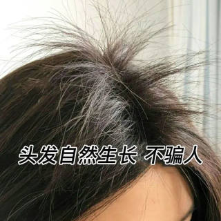 防脱发育发液女i生发液非增发密发际线头发头皮护理增长营养精华