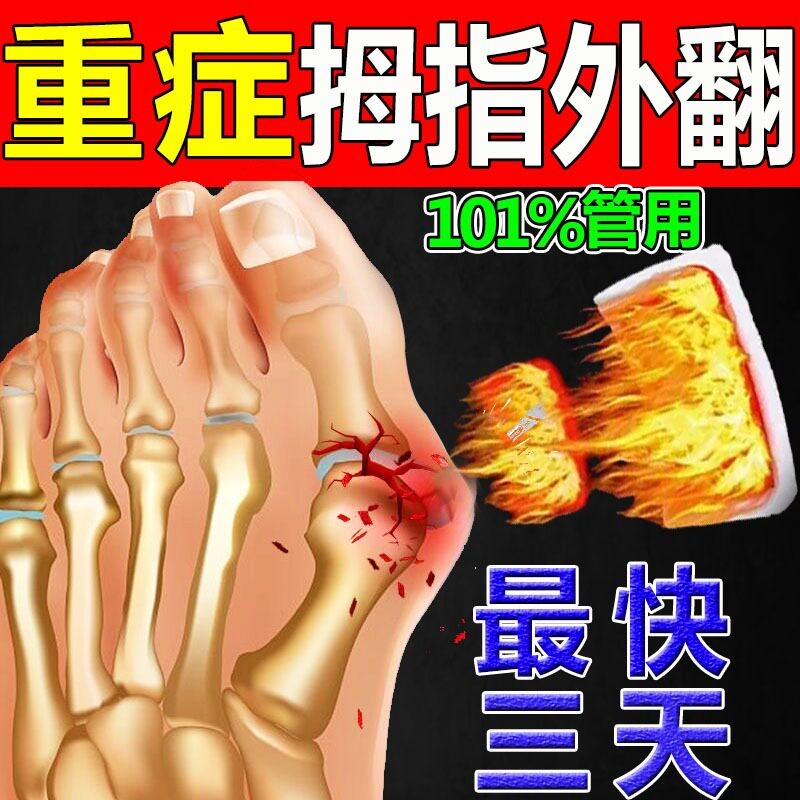 工厂销拇指外翻神器【一夜直】大脚骨矫正器拇外翻W红肿脚趾重叠