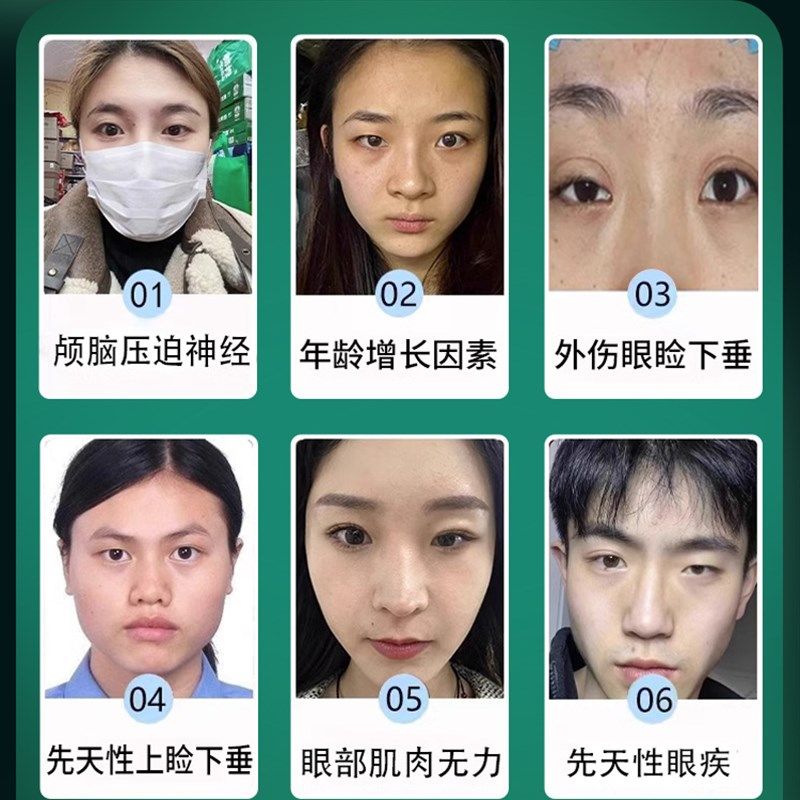 大小眼矫正器眼皮松弛下垂提拉贴肌无力肿眼泡去肿紧致双眼皮神器