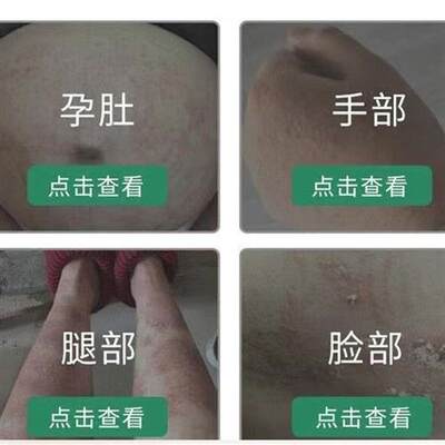 推荐《无激素孕妇可用》孕妇肚皮止痒肚子痒皮肤痒身上痒皮肤止痒