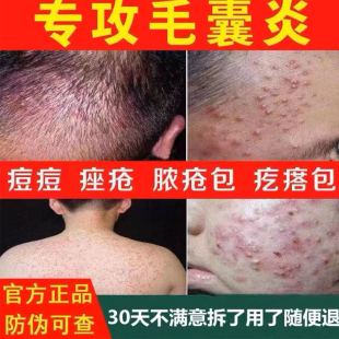 现货速发 背上长痘痘前胸后背脖子除螨专用喷剂止 三天灭 毛囊焱