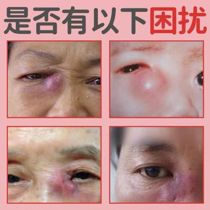 工厂销眼a结石滴眼液迎风流泪眼水泪囊炎眼睛干涩模糊发痒眼痒红