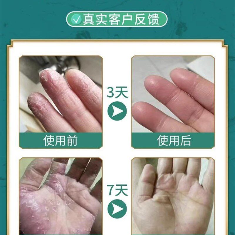 速发掌跖角化症掌趾脓疱脓包病症治疗手脚脓包角化u病蜕皮干裂病
