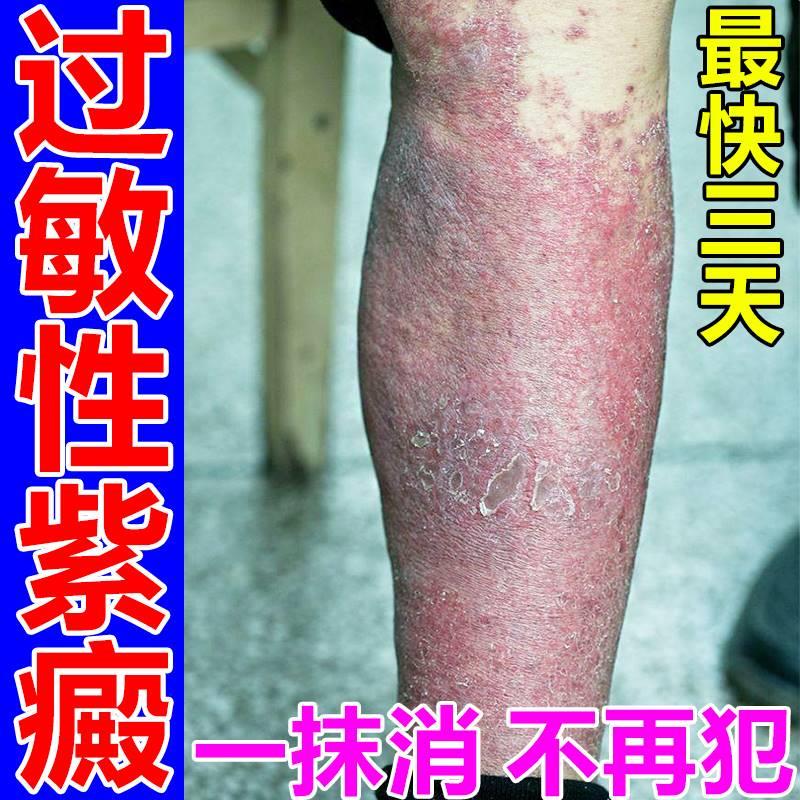 速发紫癜特效药治疗皮下出血红点瘀滞色素过敏性顽固皮炎血管炎外