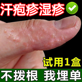 手上起小水泡汗状疱疹止痒汗泡药膏鹅掌风特效药真菌感染手气膏