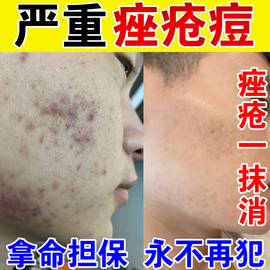 痤疮膏祛痘重度暗疮去淋巴痘腮边痘脸上面部玫瑰座疮修复特效药膏