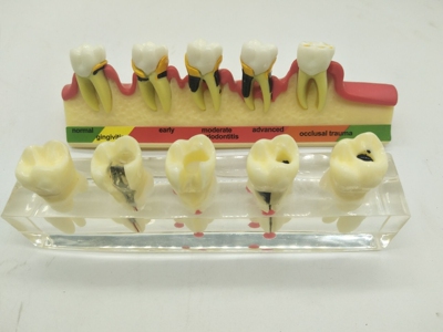 牙科材料 根管病理模型 牙周病模型  沟通模型 教学  饰品 齿科
