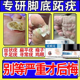 石疣去猴子肉粒疙瘩治瘊子跖疣特专用膏效去鸡眼根足部脚底疣MY