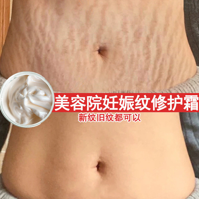 妊娠纹修复霜产后去孕纹淡化胖纹预防生长纹润肤紧致修护疤痕膏