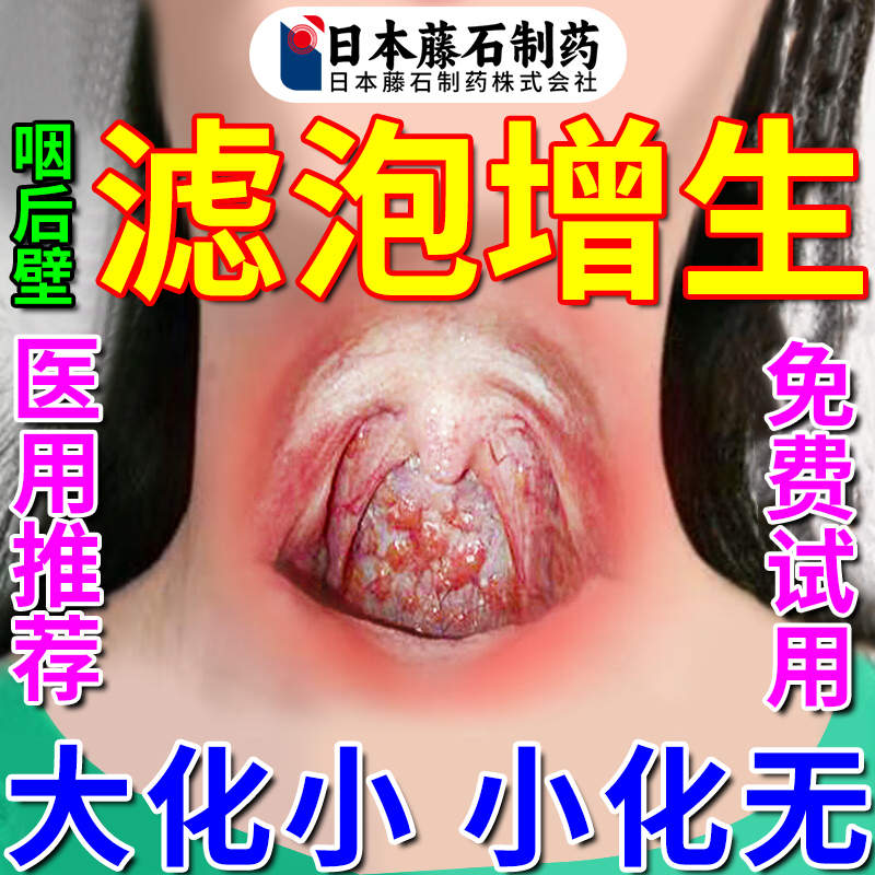 日本监制咽后壁淋巴滤泡增生慢性咽炎咽喉炎异物感喷雾剂喉咙SC