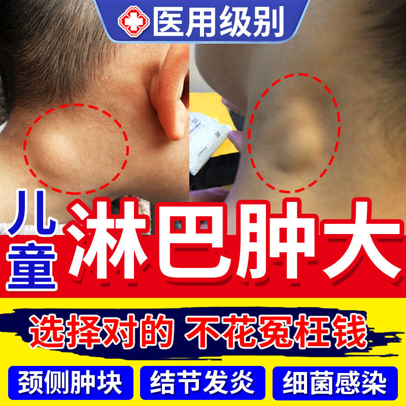 儿童淋巴结肿大消散膏脖子颈部结节消散结贴膏消除炎中药房同款TU