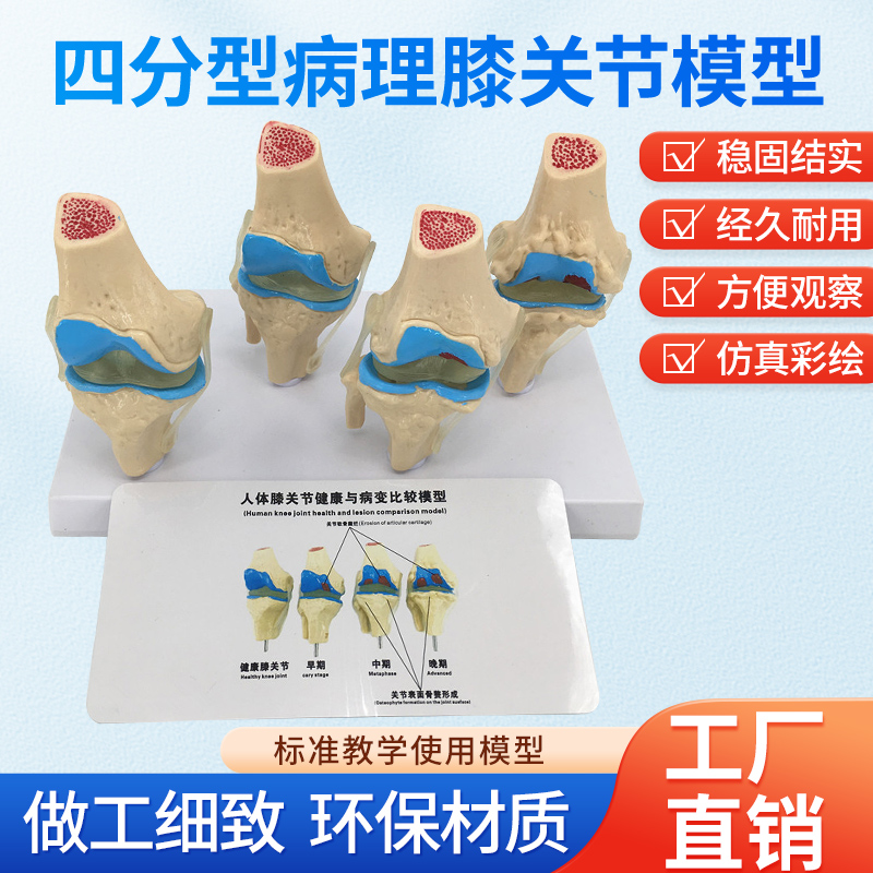 人体四阶段病理膝关节骨骼结构解剖模型病态膝盖骨质教学骨科展示
