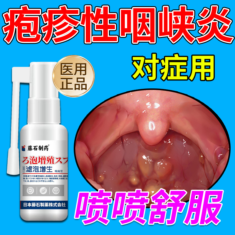 疱疹性咽峡炎喷雾儿童干扰素滤泡增生咽喉炎喷剂咽痛发热呕吐js