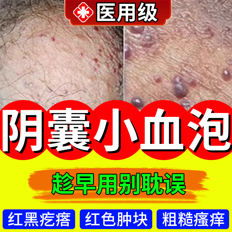 阴囊血管角化瘤阴囊湿疹瘙痒蜘蛛痣红斑血泡疼痛生殖器红色硬块HV