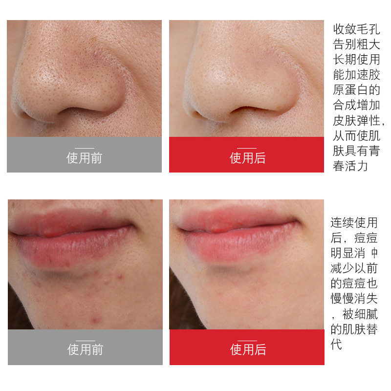 寡肽精华30ml去淡化痘印痘疤冻干粉祛痘护肤品面部修复精华液男女