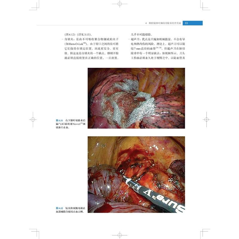 【新华文轩】胸腔镜肺叶肺段切除术图解与视频 正版书籍 新华书店旗舰店文轩官网 上海科学技术出版社 - 图1