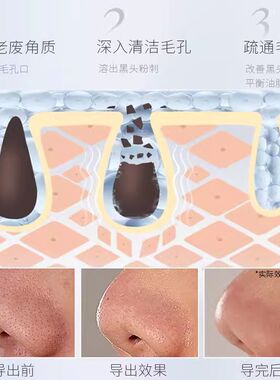 1. 聂美人黑头导出液 深层清洁黑头粉刺毛孔收缩精华液粗大修复