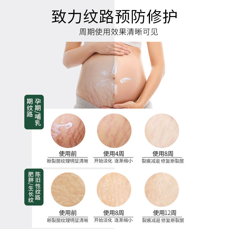 欧梵路孕妇专用防去妊娠淡化修复霜 欧梵路妊娠纹护理