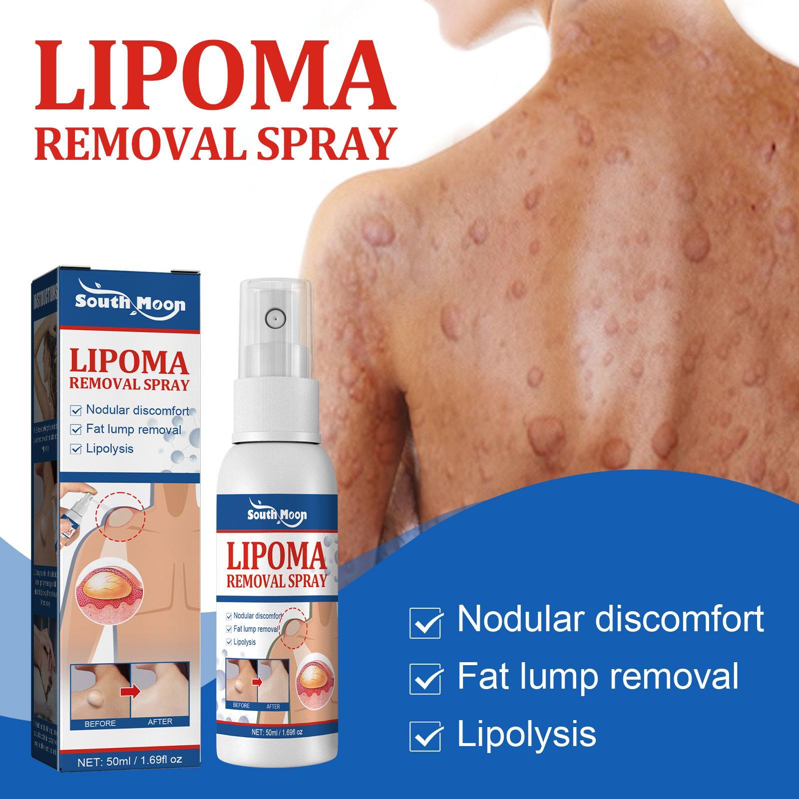 Lipoma Removal Cream Wart Treatment Cream Warts Removal Anti-图1