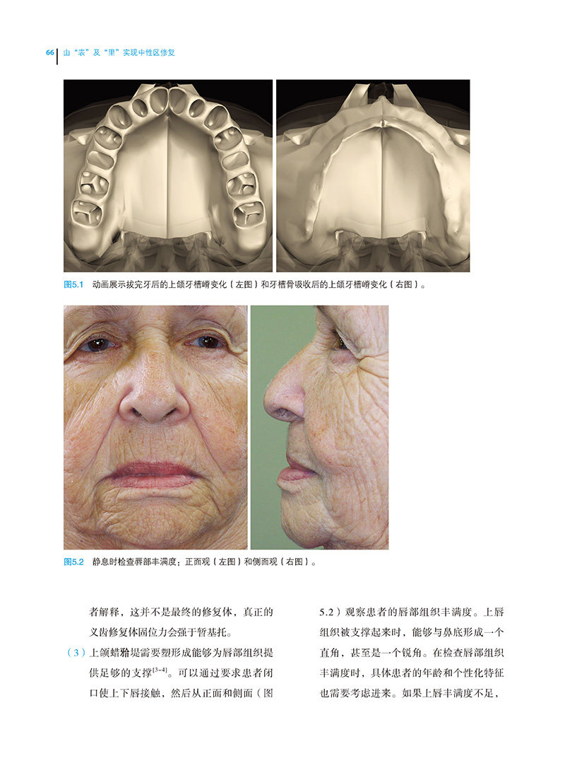 由表里实现中性区修复约瑟夫义齿 世纪在线图书口腔科学