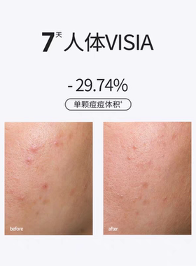 三蛋丸sounder one20%壬二酸密集焕颜乳霜乳控油祛痘面霜15g
