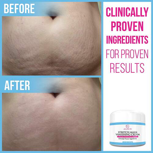 美国Mommy Knows Best Stretch Mark Cream Vanishing 4 oz - 图1