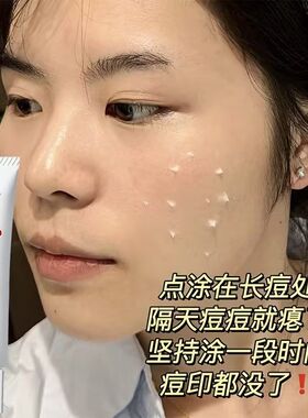 20%壬二酸凝胶祛痘膏痘印坑修复淡化膏任二水杨酸去黑头收缩毛孔