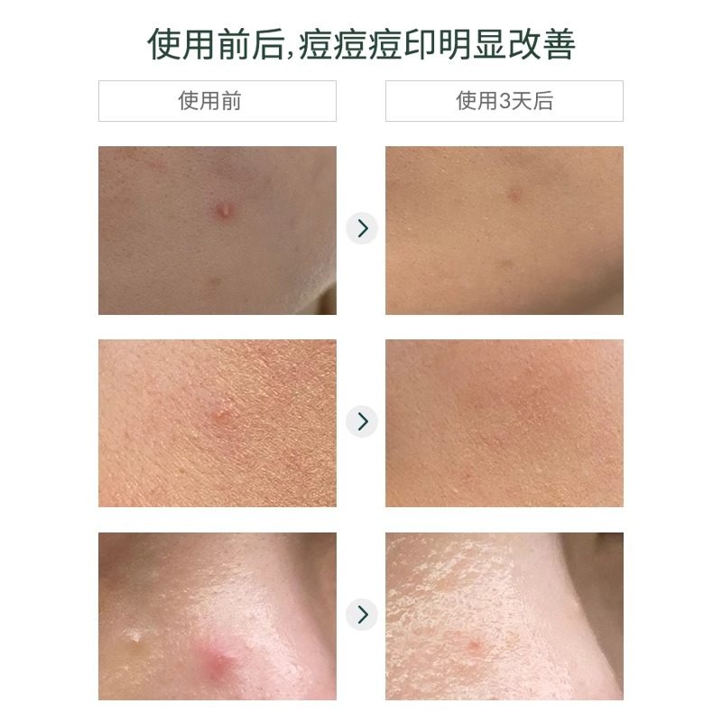 韩国正品carenology95科娜蓝祛痘膏淡化痘印闭口痘痘膏枇杷修护膏,淘宝优惠券,粉丝福利购,淘宝优惠卷