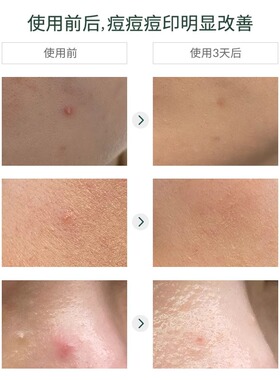 科娜蓝枇祛痘膏10g淡化痘印闭口