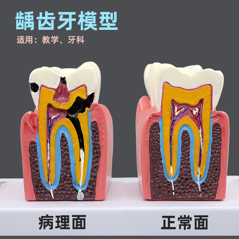 牙科口腔蛀牙龋齿牙病解剖模型牙齿结构模型幼儿园教学刷牙模型 - 图0