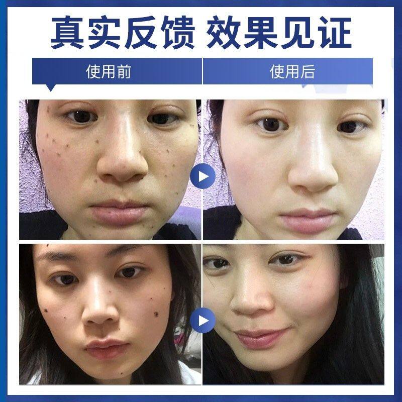 去痣点痣专用药水脸部点斑黑点痦子祛痣美容院点痣膏正品神器仪_虎窝淘