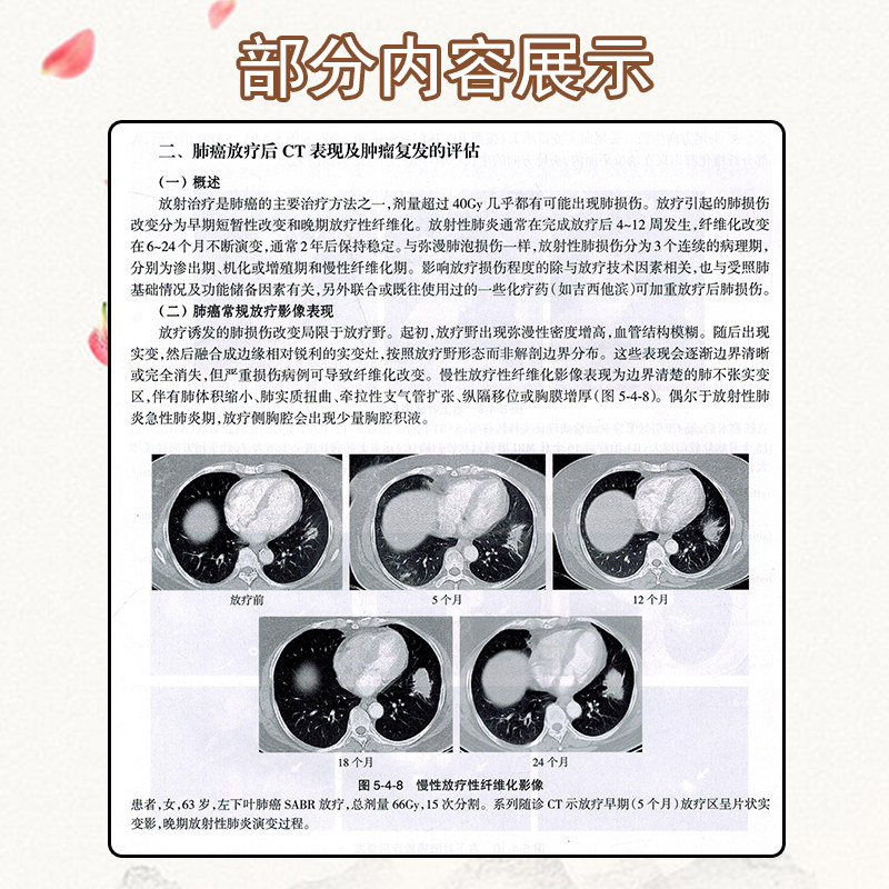 正版 临床肿瘤规范化诊疗实践与进展 肺癌分册 王洁 医院肿瘤肺癌专业诊断治疗外科手术放疗靶向治 人民卫生出版社9787117325509