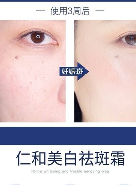 祛斑霜正品第一名淡化斑点韩熙美白祛斑霜面霜晒斑淡斑