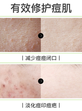 馥珮祛痘精华液25ml去青春痘粉刺背部淡化痘印男女士学生化妆品正