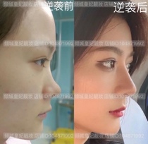 Lean nose nose pretty nose and nose snuggled nose essential oil Mountain root nasal beam heightening of fine Chinese liquid shake systolic nose wingers