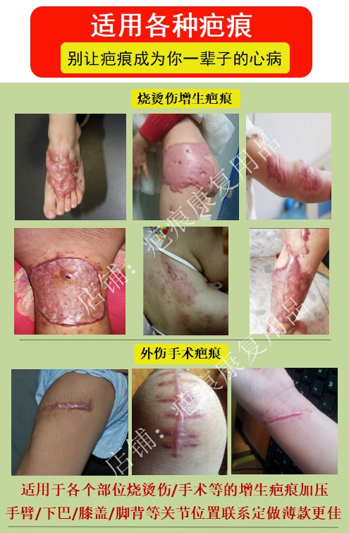 弹力套疤痕加压垫硅胶垫压力垫疤痕增生压力套烧烫伤术后疤痕贴,淘宝优惠券,粉丝福利购,淘宝优惠卷